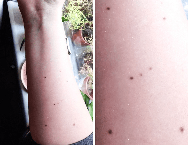 freckles