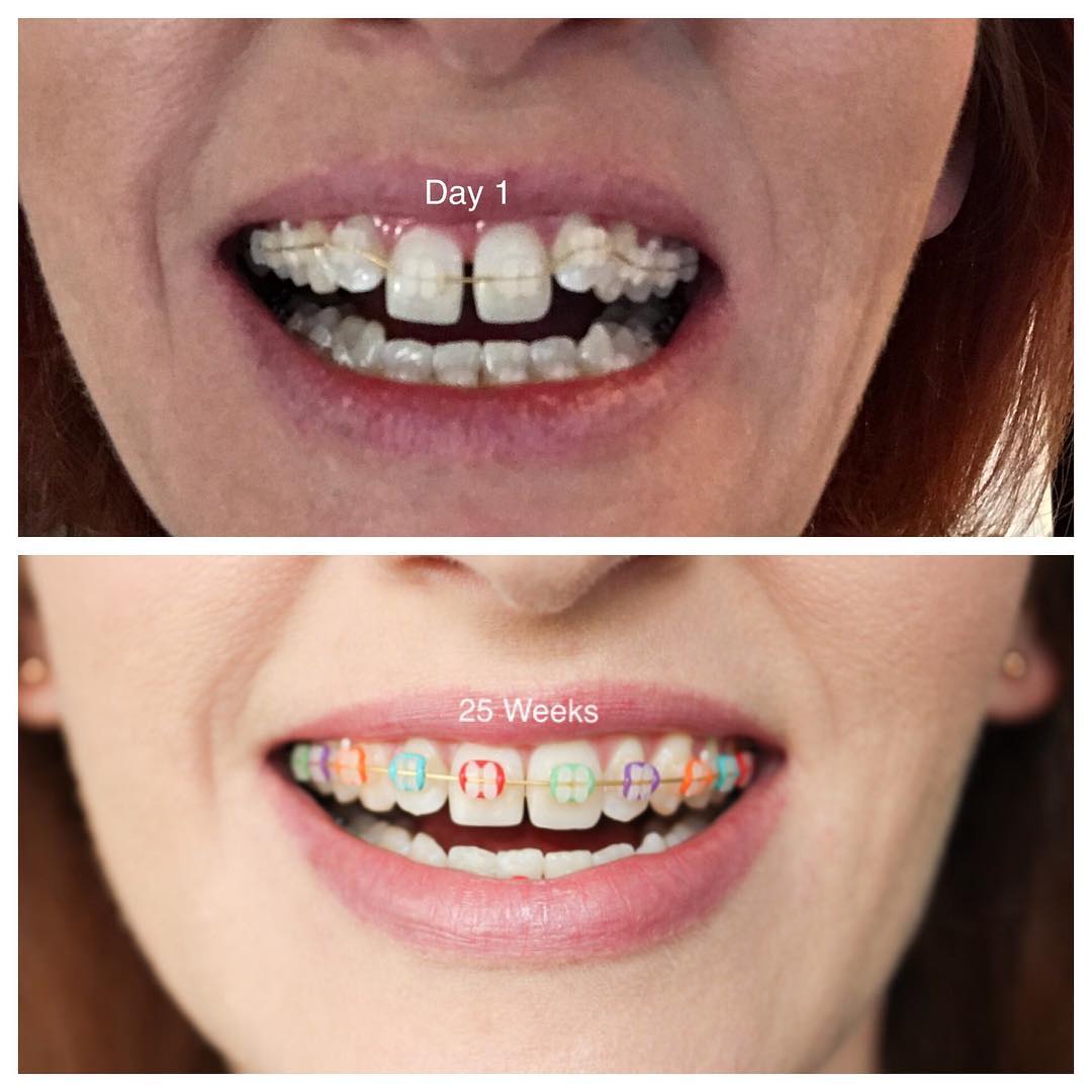 15 Drastic Transformations Of People Before And After Braces