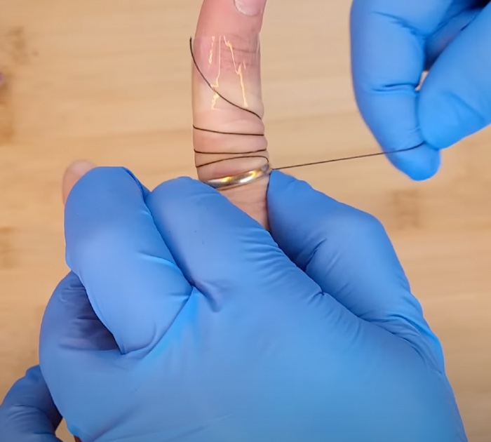 Woman shares simple trick the doctor showed her to remove stuck ring ...